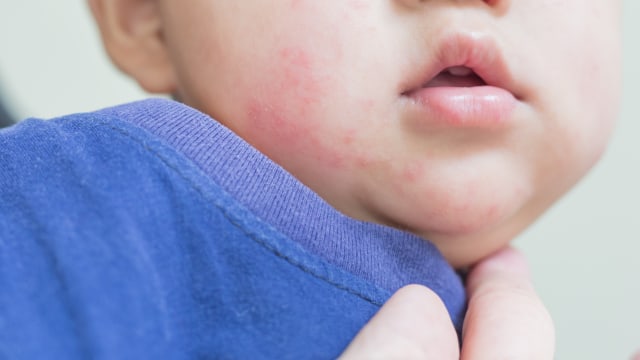 Ilustrasi bayi alergi Foto: Shutterstock