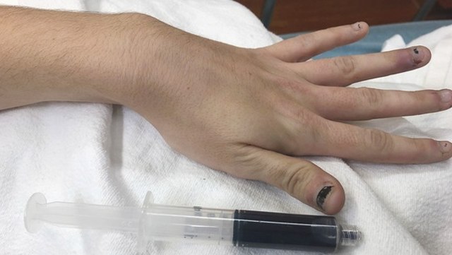 Penampakan darah berubah jadi berwarna hitam. Foto: New England Journal of Medicine (NEJM).