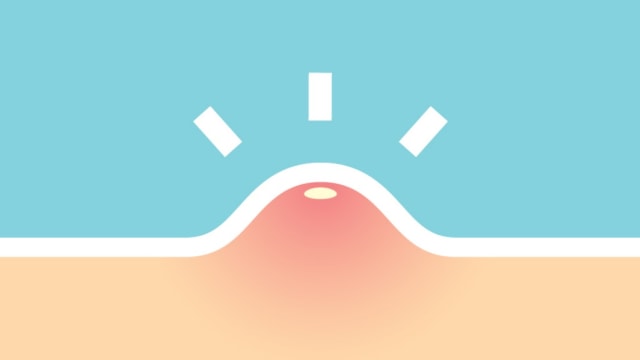 Jerawat juga bisa menyerang anak balita  Foto: Shutterstock