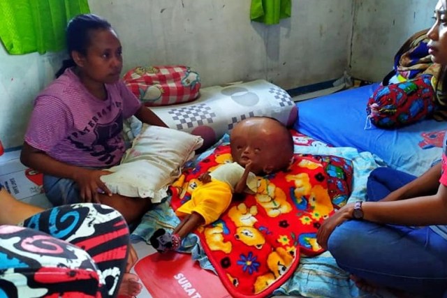 Disanto Runaki, balita penderita hidrosefalus. Foto: Dok. Balleonews