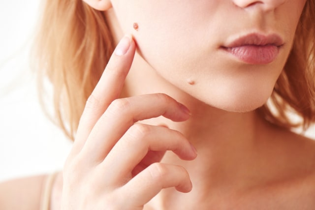 Ilustrasi tahi lalat. Foto: Shutter Stock