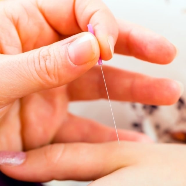 Ilustrasi akupuntur Foto: Foto: Thinkstock