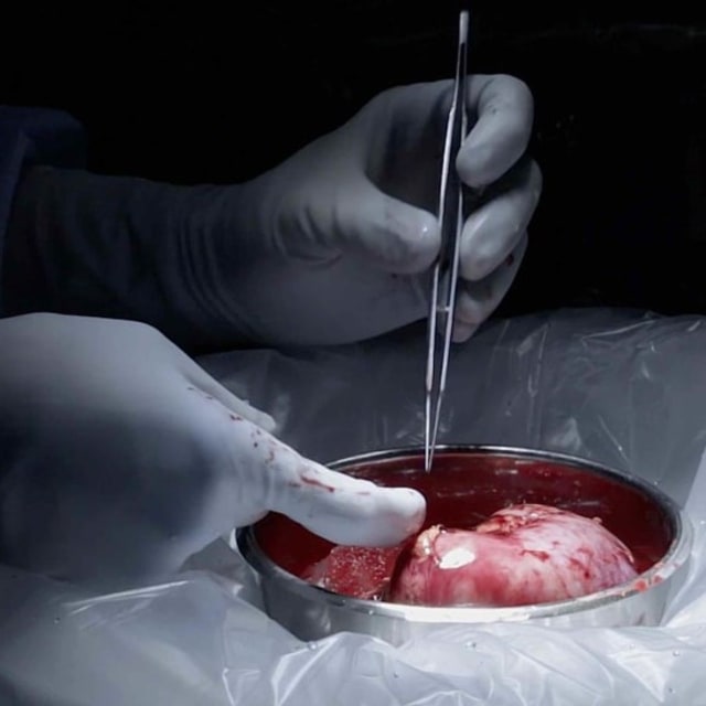 Ginjal transplantasi. Foto: Foto: AP