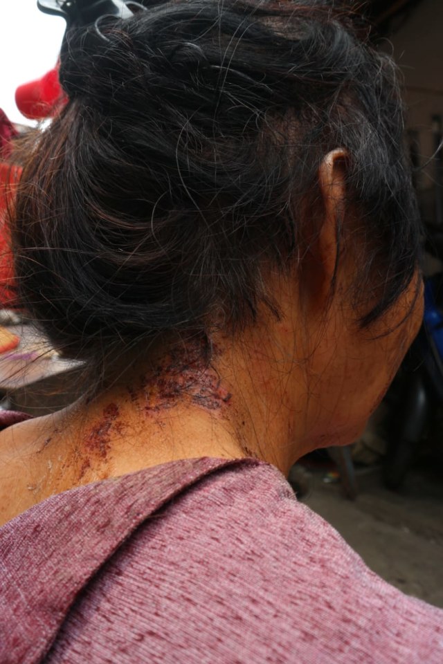 Luka penyiraman air keras di tubuh Sakinah. Foto: Ulfa Rahayu/kumparan