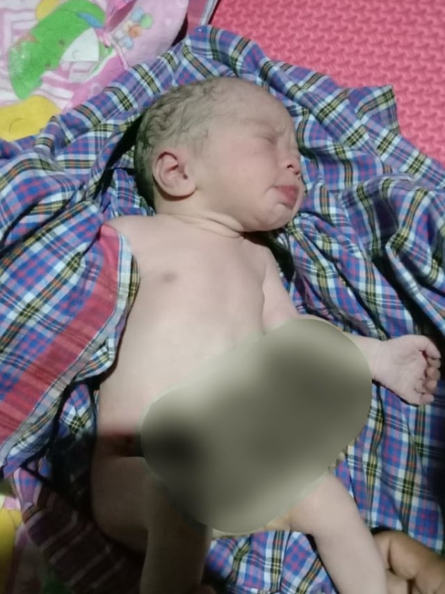 Bayi di Madina Sumut lahir dengan kondisi Gastrochisis akibat pencemaran lingkungan tambang emas. Foto: Dok. Istimewa