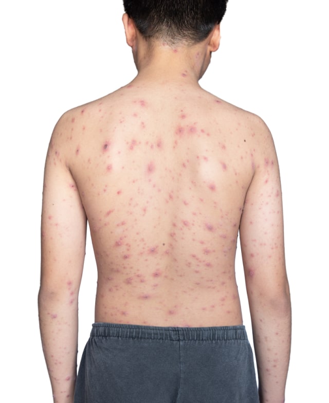 Anak Cacar. Foto: Shutterstock