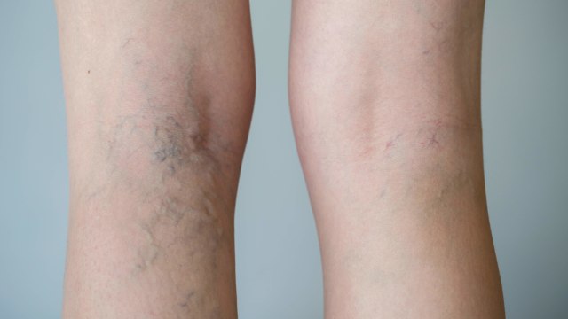 Varises kaki. Foto: Shutterstock