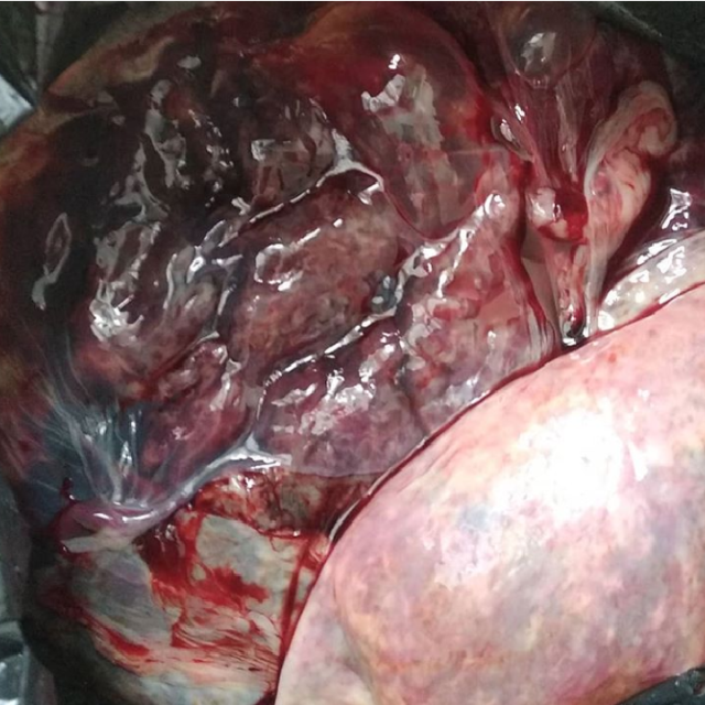 Pengapuran Plasenta: Plasenta Sudah Tua Di Kehamilan 28 Minggu