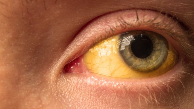 Ilustrasi Hepatitis A. Foto: Shutter Stock