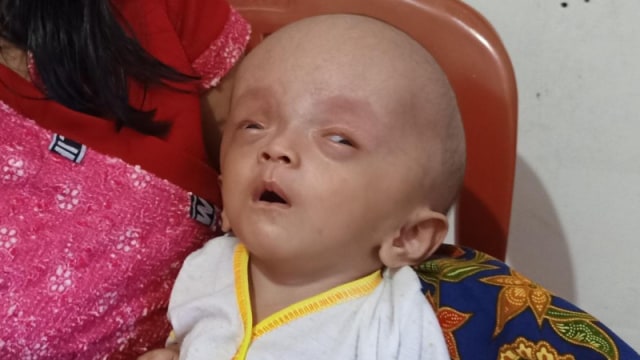 Bayi Tolitoli yang masih berusia 4 bulan mengidap penyakit hidrosefalus. Foto: Moh. Sabran/PaluPoso