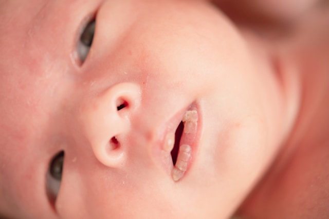 Ilustrasi bibir bayi pecah-pecah. Foto: Shutter Stock