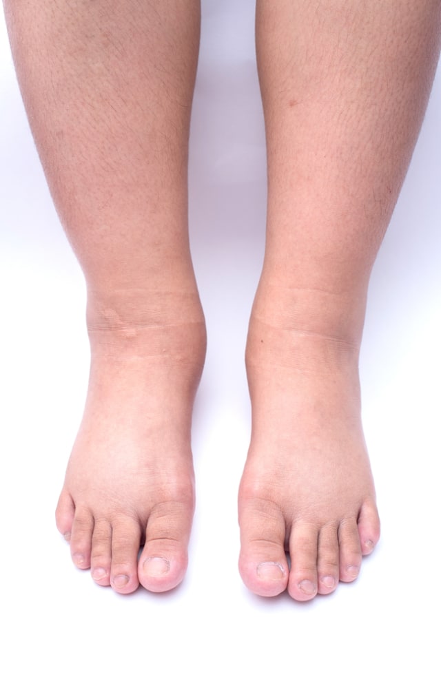 Edema pascamelahirkan PTR Foto: Shutterstock