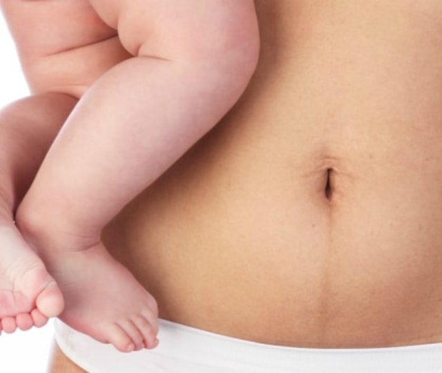 Perut ibu setelah melahirkan. Foto: Shutterstock