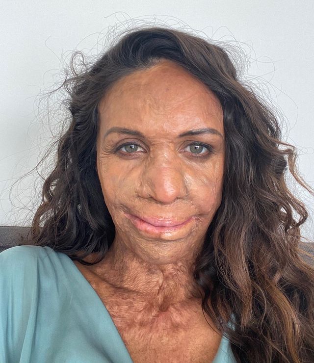 Turia Pitt, Kisah Perempuan Korban Kebakaran Hutan Australia yang Telah Melalui 200 Operasi. Foto: dok. @turiapitt/ Instagram