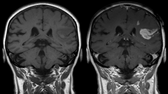 Foto: Stroke adalah kondisi dimana pasokan darah menuju otak terganggu