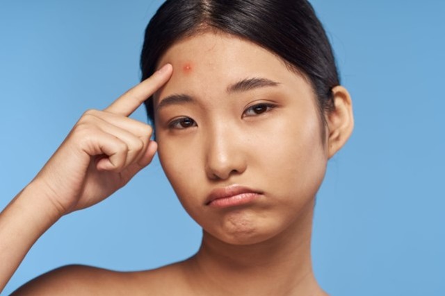 Ilustrasi bekas jerawat kemerahan  Foto: Shutterstock.