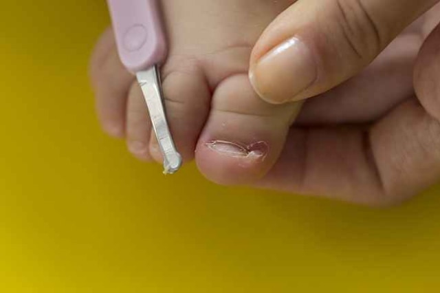 Ilustrasi kuku anak terkelupas. Foto: Shutterstock