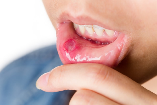 Cara Mengobati Sariawan. Foto: Shutterstock