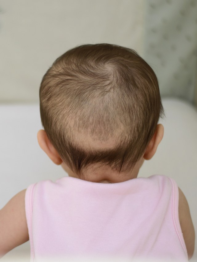 Ilustrasi kepala anak pitak. Foto: Shutter Stock