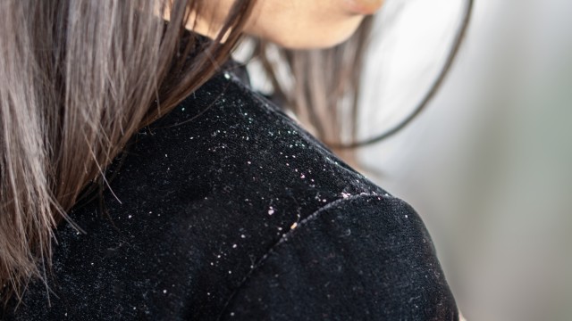 Ilustrasi ketombe kering. Foto: Shutter Stock