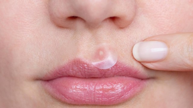 Acne patch untuk mengempeskan jerawat. Foto: shutterstock