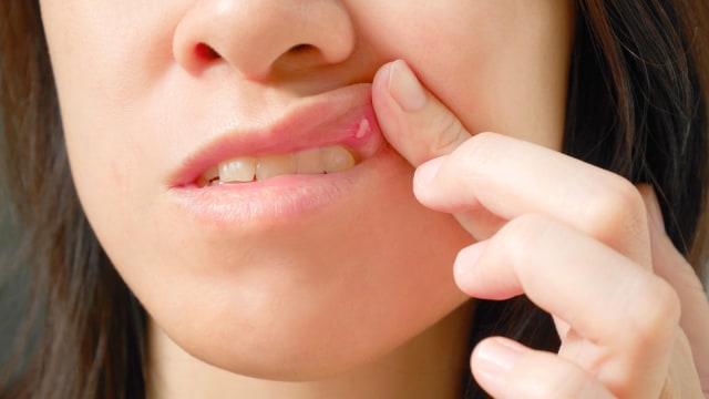 Ilustrasi sariawan. Foto: Thinkstock