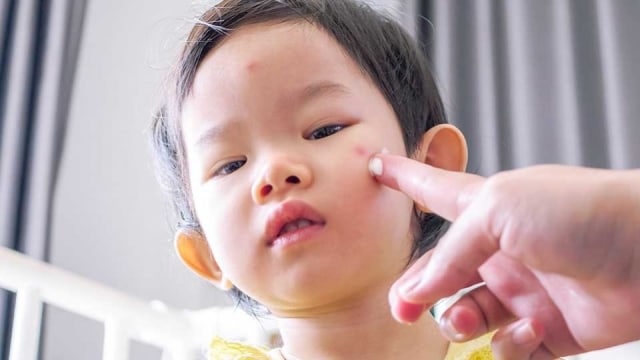 Ilustrasi penggunaan salep. Foto: Dok. kumparan