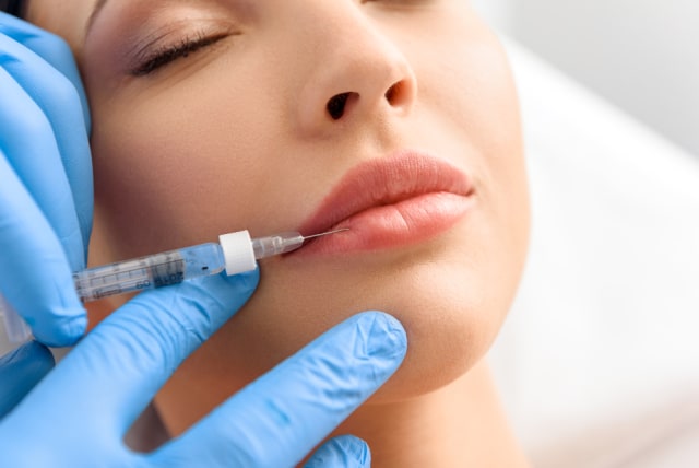 Ilustrasi filler bibir. Foto: Shutterstock
