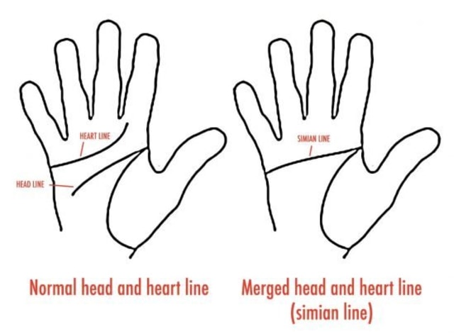 Garis tangan lurus (kanan) atau dikenal dengan simian line. Dok: jefffinley