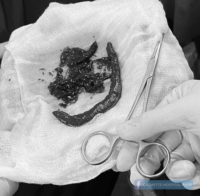 Lintah yang berhasil dikeluarkan dari penis pasien. Foto: Calmette Hospital via Facebook