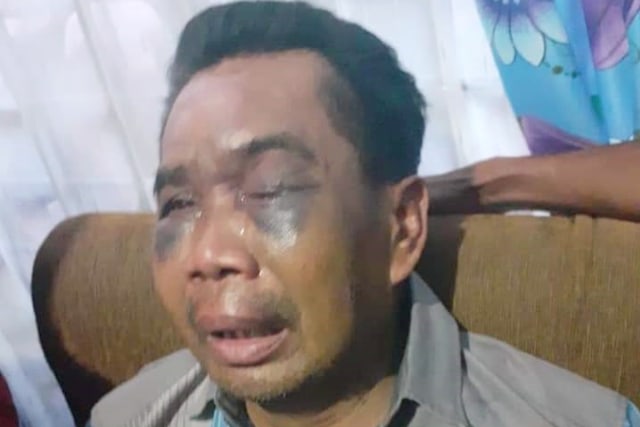 Wajah Sarpan lebam usai ditahan lima hari di Polsek Percut Sei Tuan Foto: Dok. Istimewa
