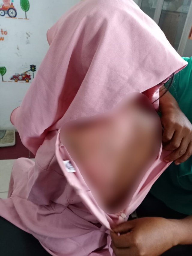 Seorang ibu berinisial NU, warga Desa Bantayan, Kecamatan Simpang Ulim, Aceh Timur, nekat menyirami anak kandungnya sendiri menggunakan air panas. Foto: Dok. Itimewa