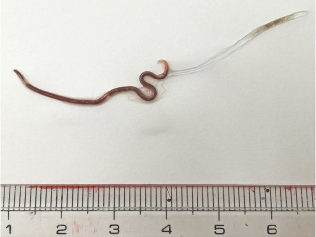 Cacing yang ditemukan di tenggorokan wanita. Foto: The American Journal of Tropical Medicine and Hygiene