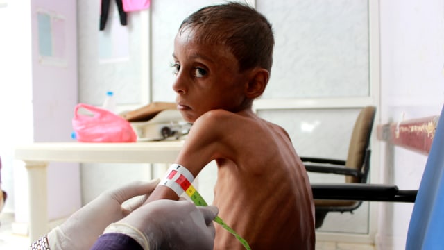 Seorang dokter memeriksa kondisi anak laki-laki malnutrisi, Hassan Merzam Muhammad, di sebuah rumah sakit di distrik Aslam provinsi Hajjah, Yaman. Foto: Eissa Alragehi/REUTERS