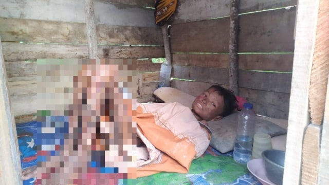 Dion Saputra, remaja yang mengidap penyakit langka di Donggala, Sulteng. Foto: Tim PaluPoso