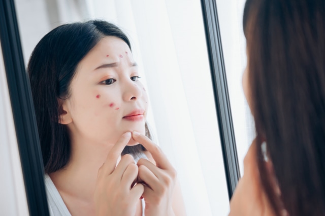 Ilustrasi Perempuan Memencet Jerawat Foto: Shutterstock