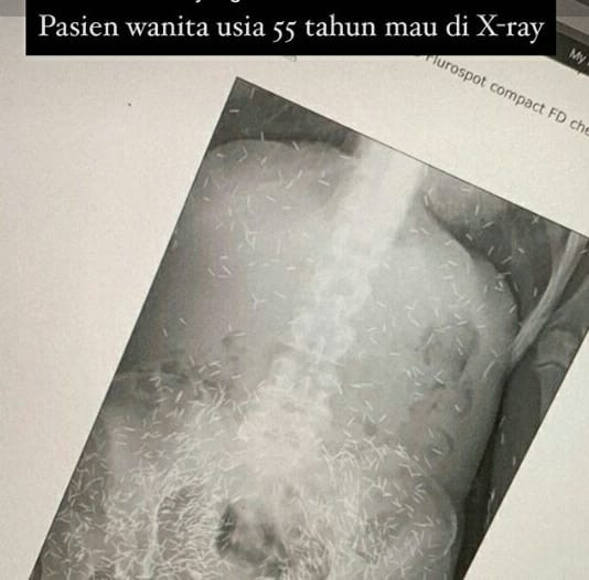 Foto penampakan ribuan jarum yang dianggap sebagai susuk, dok: Instagram/Tasyabira