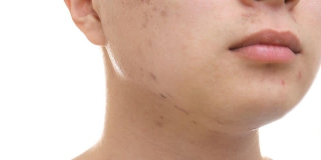 Cara alami menghilangkan bekas jerawat Foto: Dok. Shutterstock