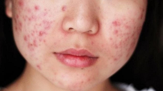 Cara menghilangkan bekas jerawat merah di wajah. Foto: Pinterest
