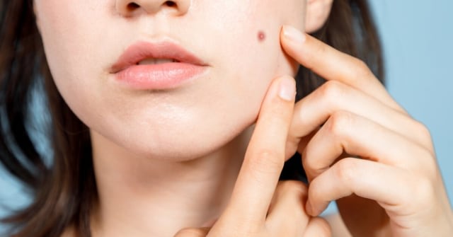 Bekas jerawat hitam di pipi Foto: australianskinclinics