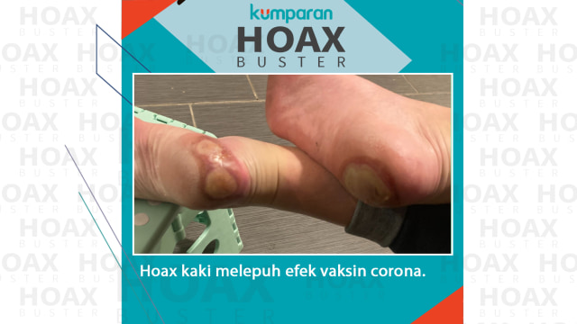 Hoax kaki melepuh efek vaksin corona. Foto: Dok. gofundme