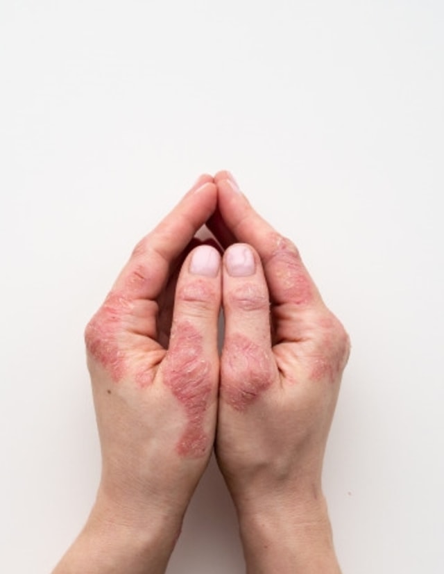 Ibu dengan Psoriasis, Apakah Boleh Menyusui? Foto: Freepik