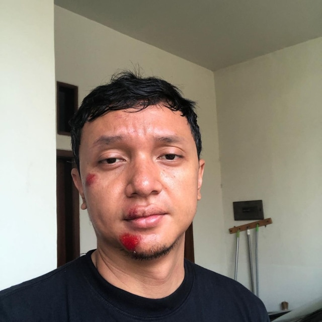Iga Massardi usai jatuh dari sepeda. Foto: Instagram/@igamassardi