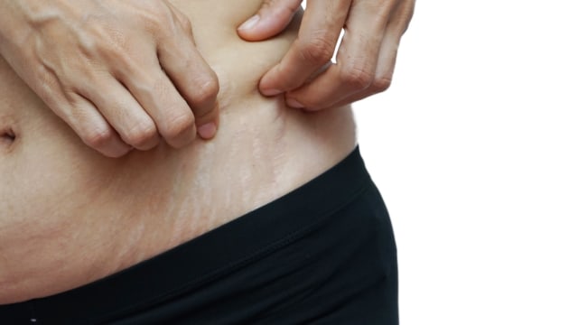 ilustrasi stretch mark Foto: Shutterstock