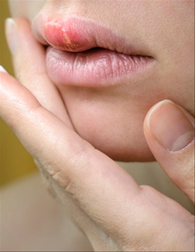 Herpes Labialis pada Ibu Hamil Apakah Berbahaya bagi Janin? Foto: Freepik