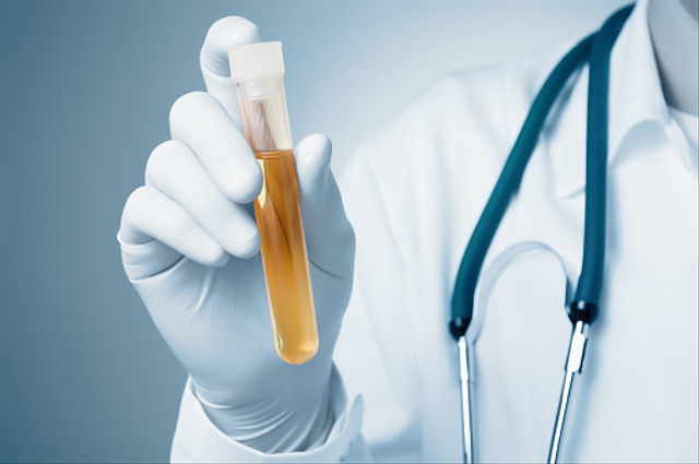 Ilustrasi urine. Foto: iStock