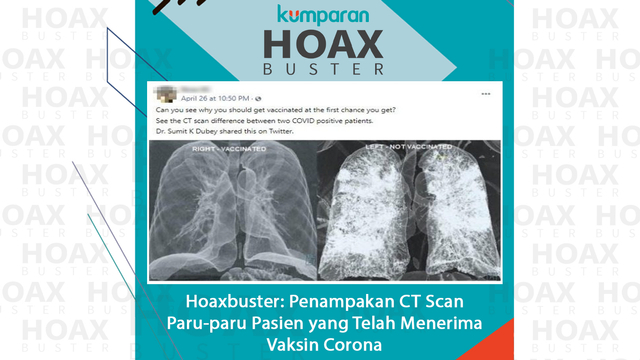 Hoaxbuster: Penampakan CT Scan Paru-paru Pasien yang Telah Menerima Vaksin Corona.

 Foto: kumparan