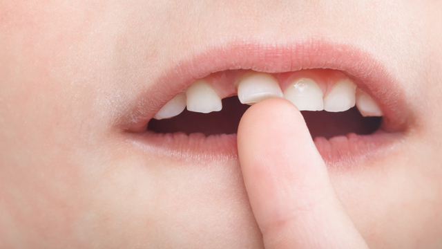 Kapan Gigi Susu Anak Mulai Copot? Foto: Shutter Stock