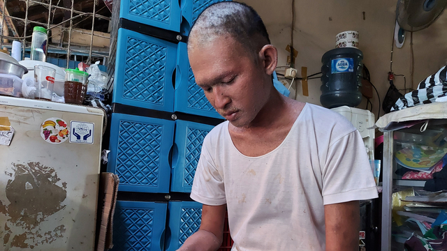 Andhik Herawana, warga Karanganyar yang mengidap penyakit kulit aneh