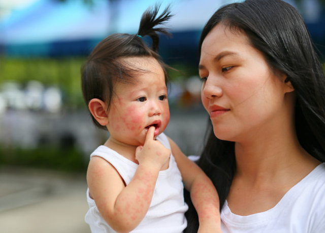 Ilustrasi Cara Mengatasi Biang Keringat pada Bayi. Foto: Freepik